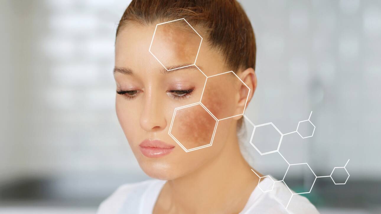 Hiperpigmentacija lica, Facial hyperpigmentation