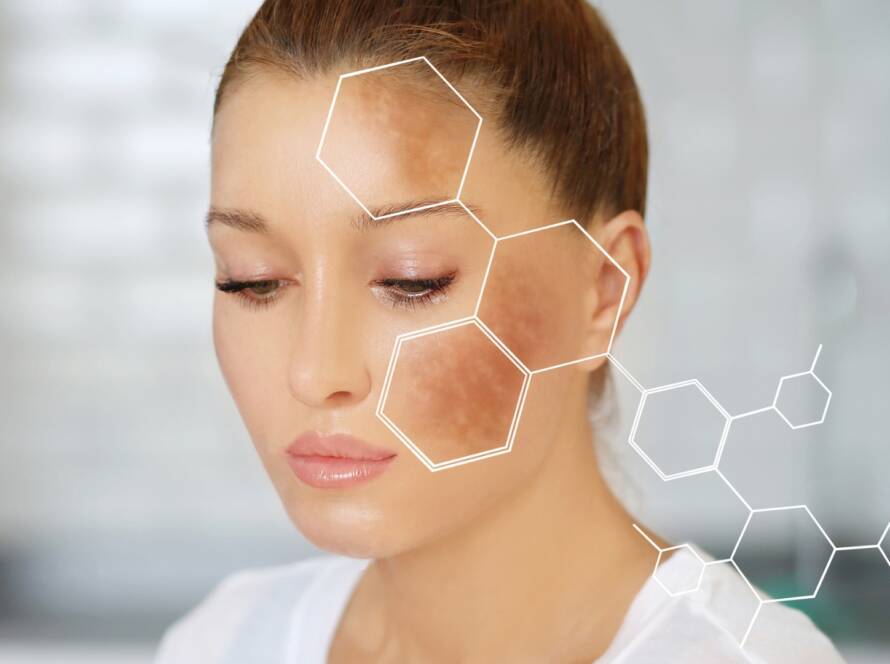 Hiperpigmentacija lica, Facial hyperpigmentation