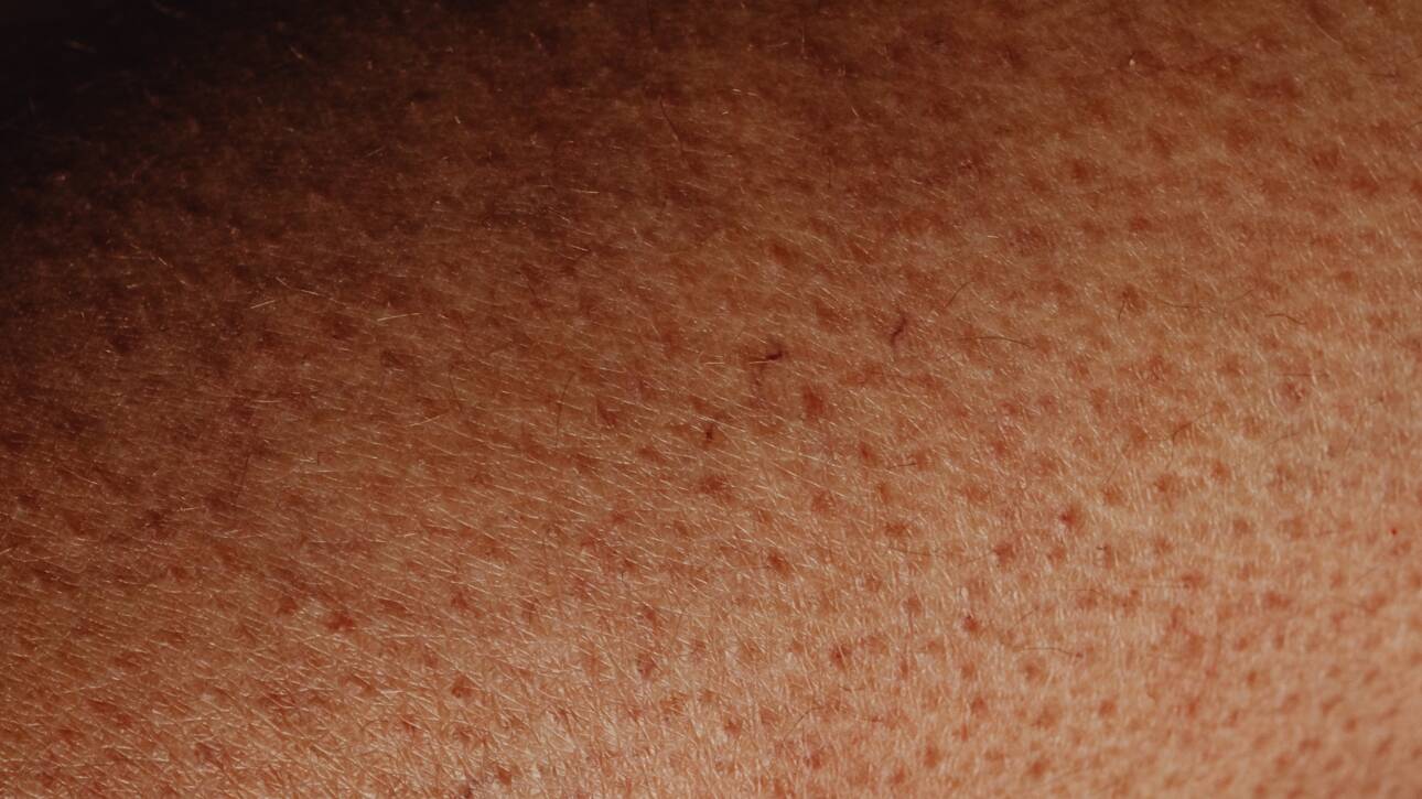 Hormonske promjene na koži