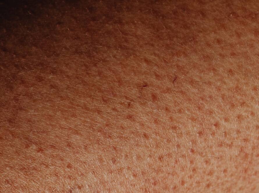 Hormonske promjene na koži