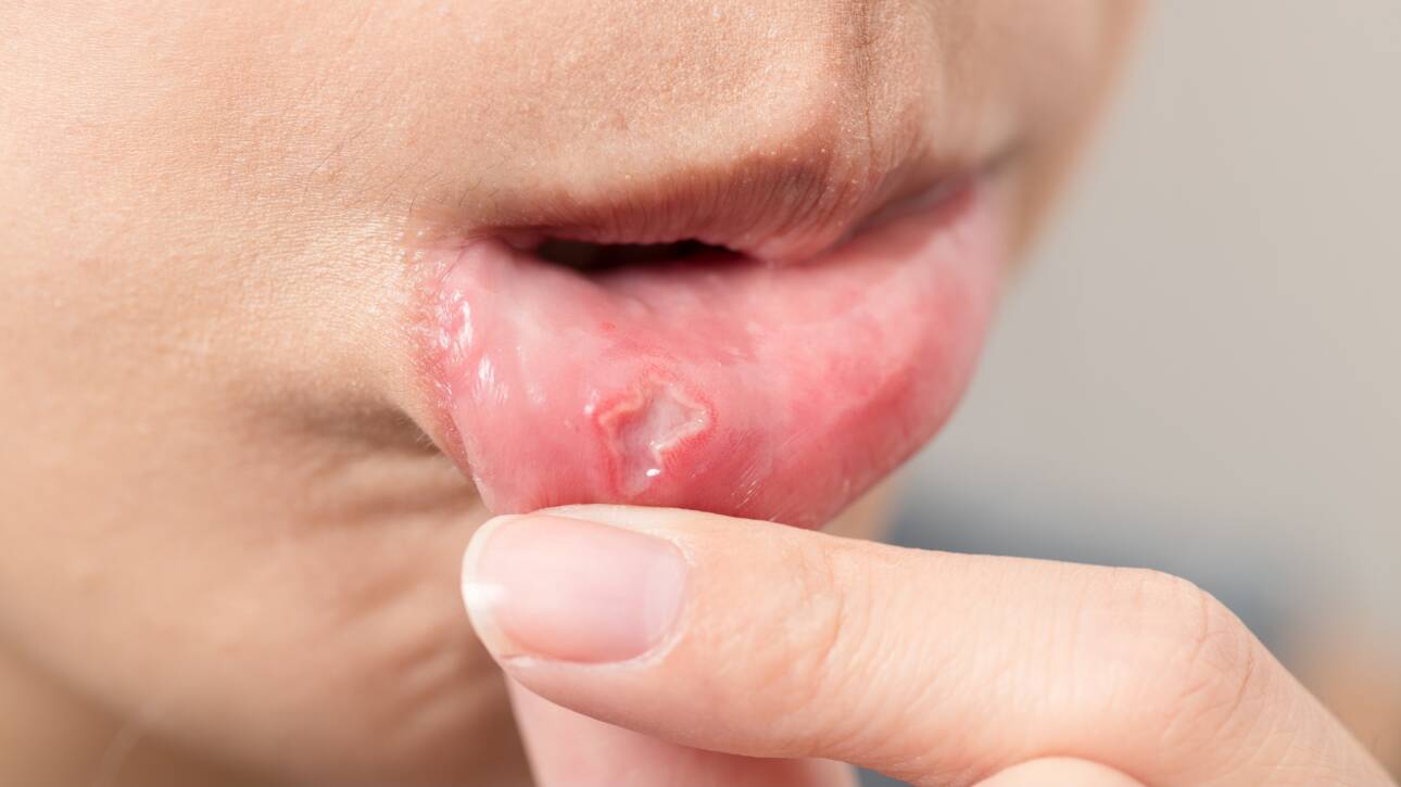 Esthea - Afte, canker sores