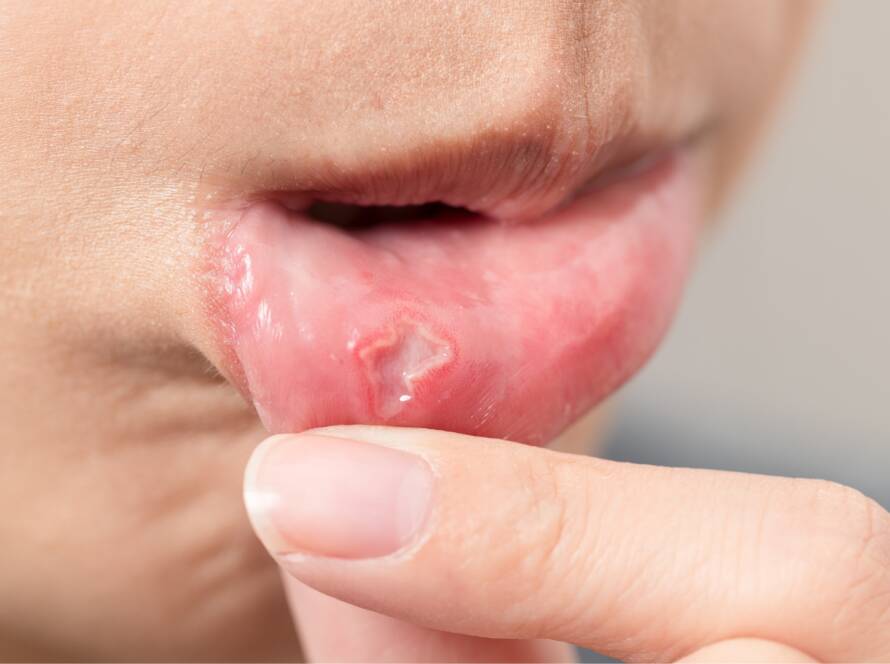 Esthea - Afte, canker sores