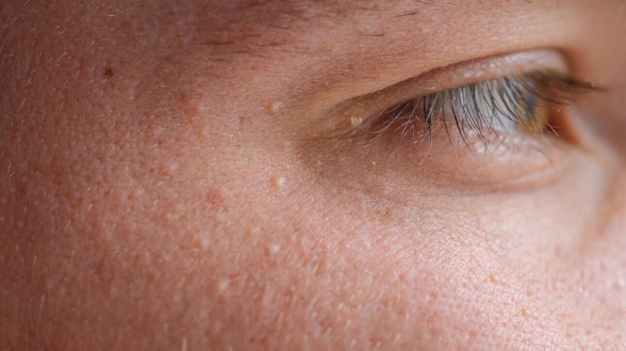 Esthea - Milije, milia