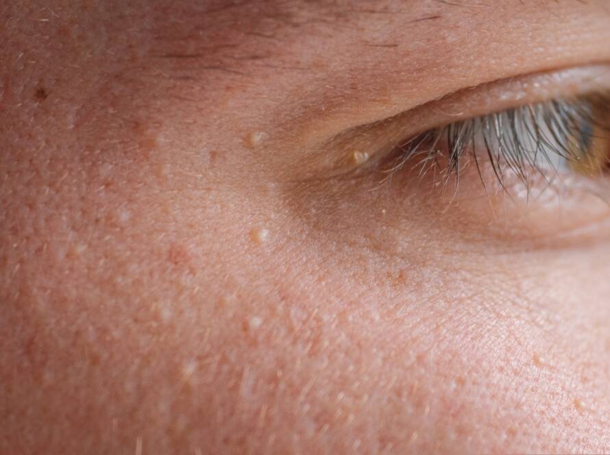 Esthea - Milije, milia