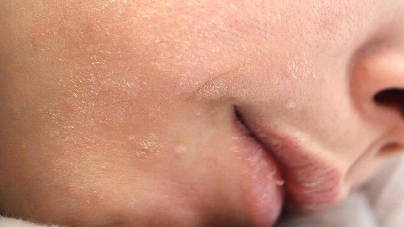 Esthea - Koža zimi - Winter skin