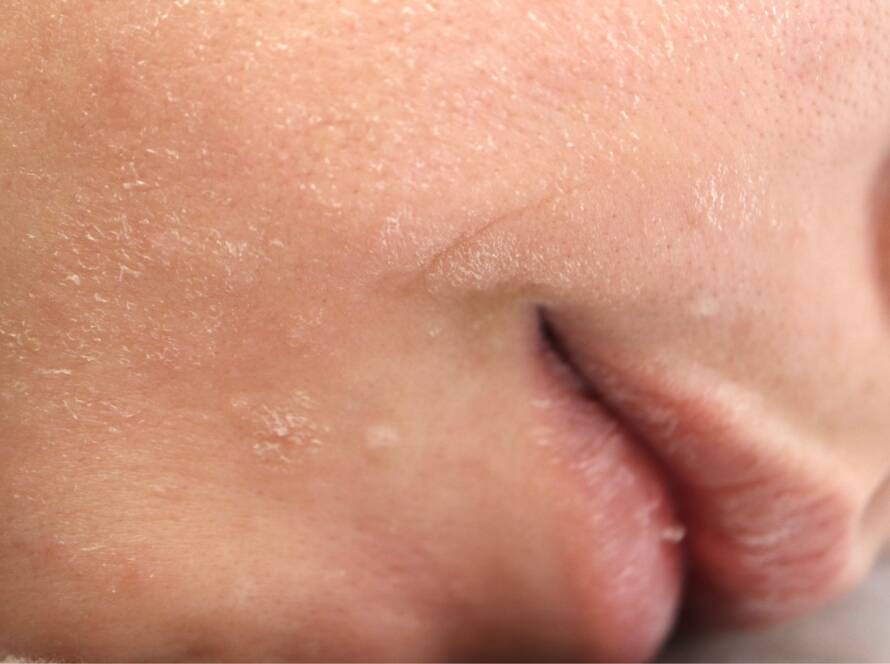 Esthea - Koža zimi - Winter skin