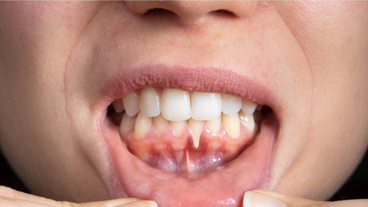 Esthea - Povlačenje zubnog mesa - Receding gums (gingival recession)