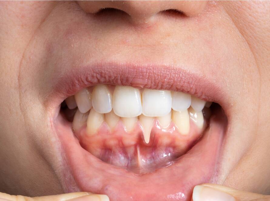 Esthea - Povlačenje zubnog mesa - Receding gums (gingival recession)