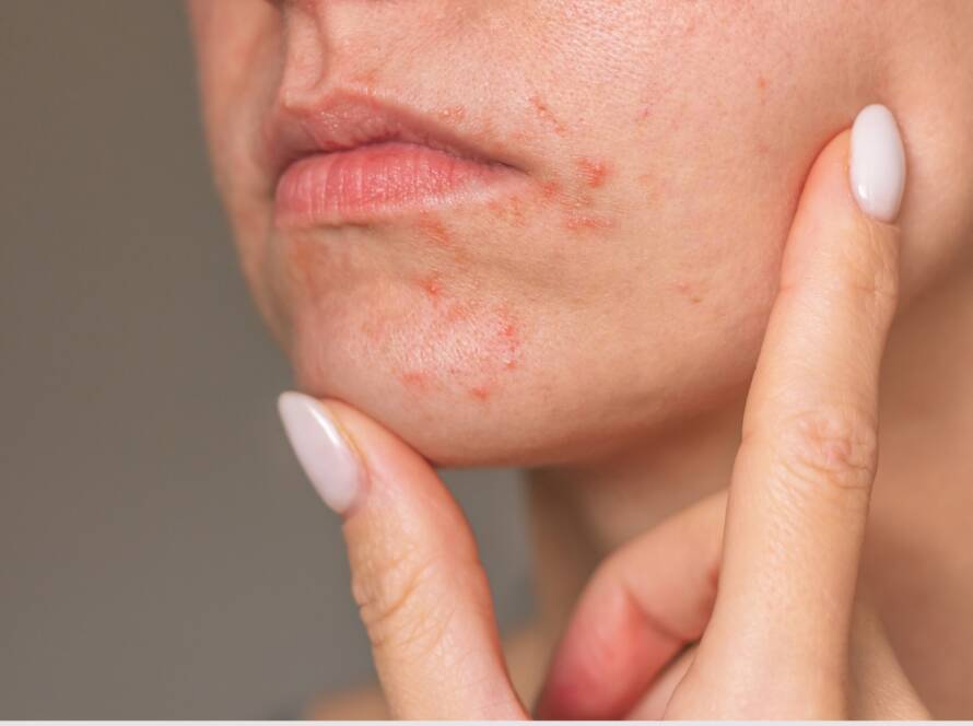 Dermatitis lica, facial dermatitis