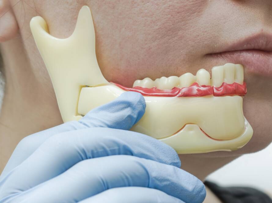 Esthea Atrofija čeljusne kosti, jawbone atrophy