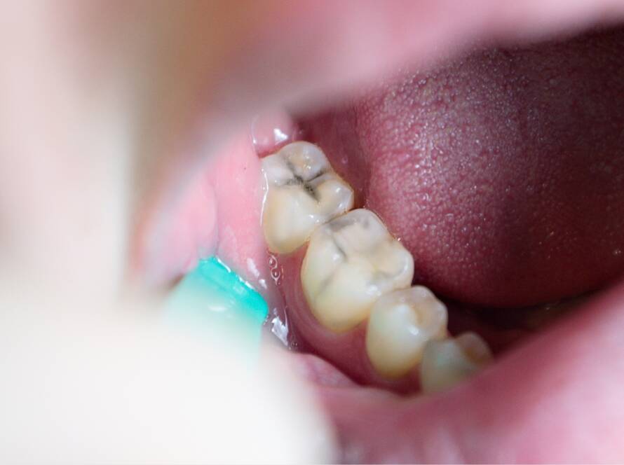 Karijes, caries