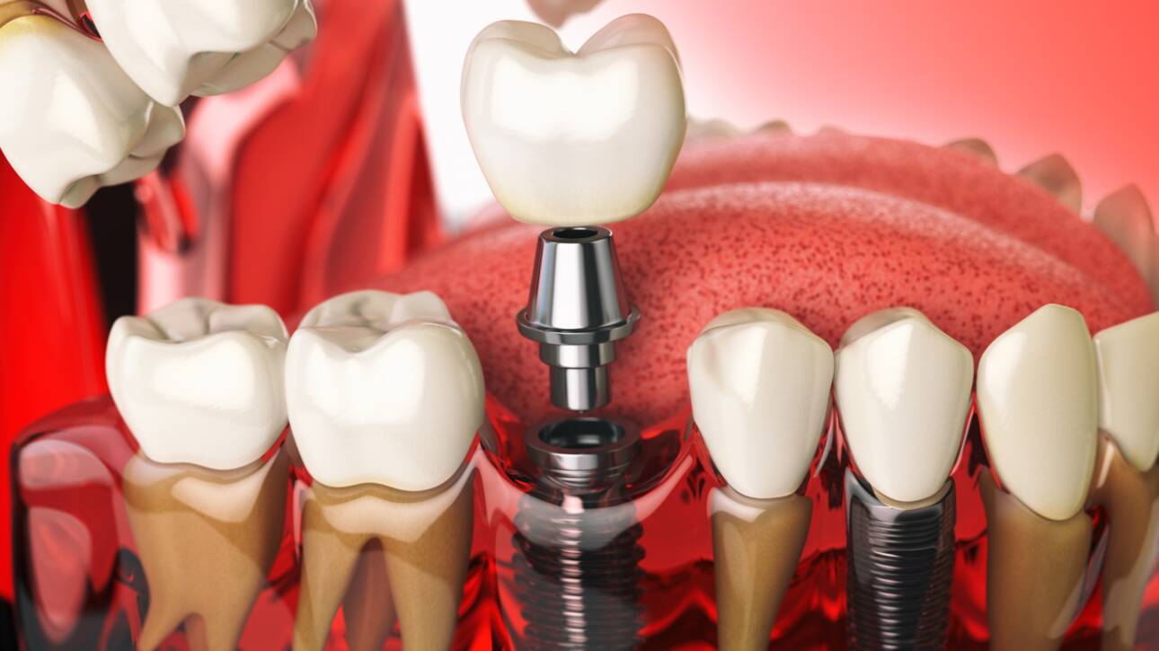 Periimplantitis, Peri-implantitis