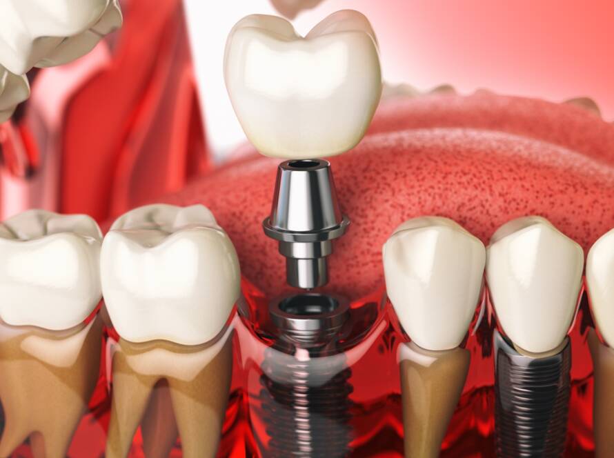 Periimplantitis, Peri-implantitis