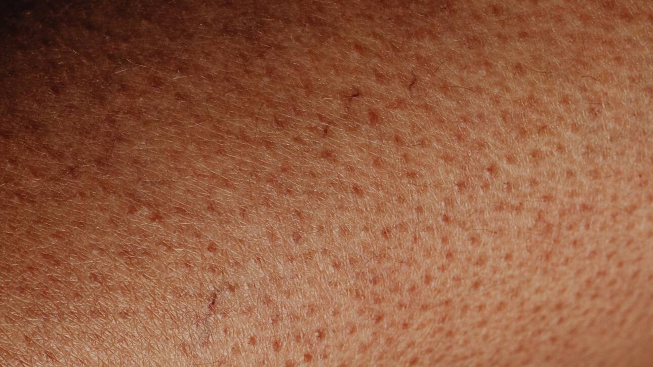 Proširene pore, Enlarged pores