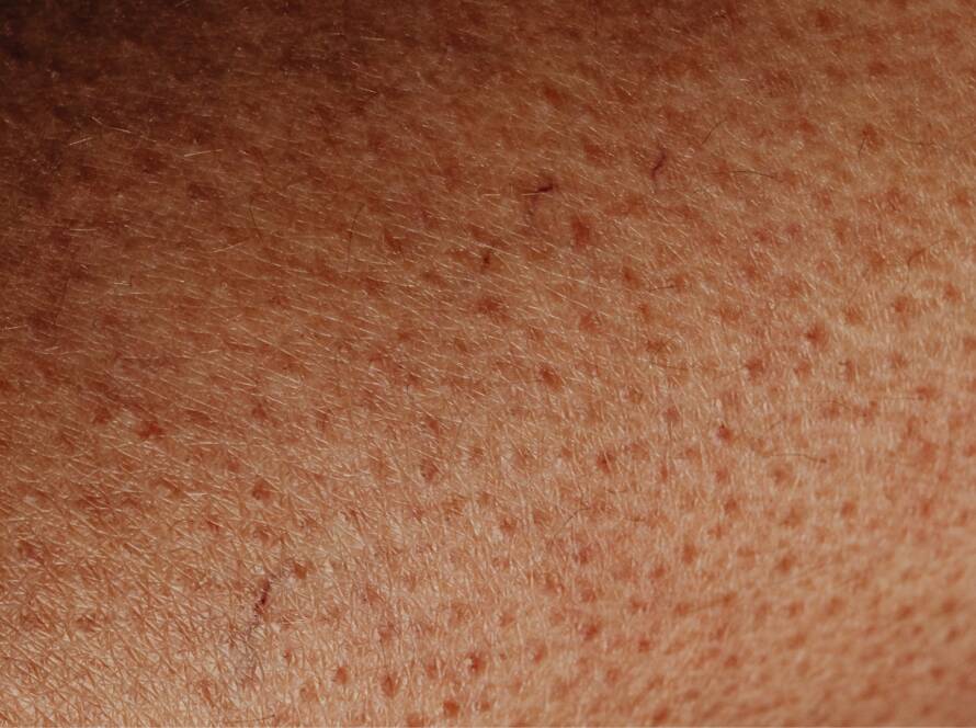 Proširene pore, Enlarged pores