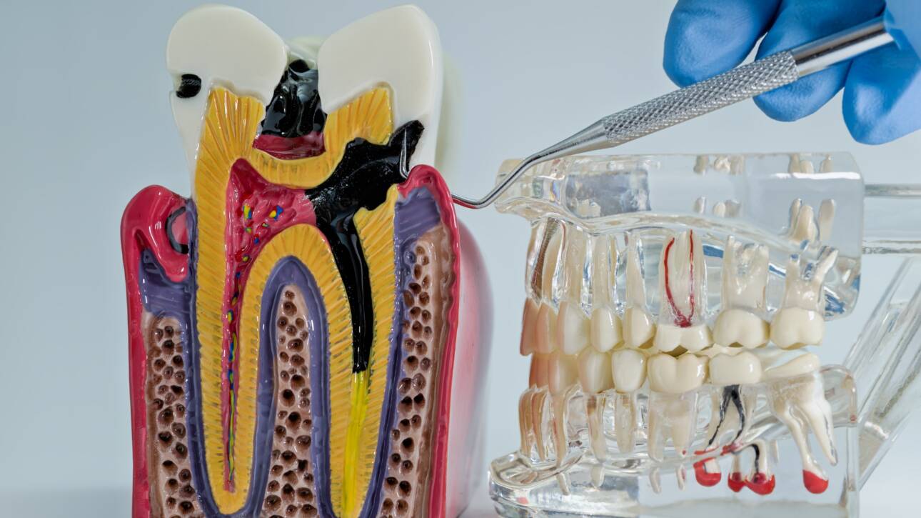 Pulpitis