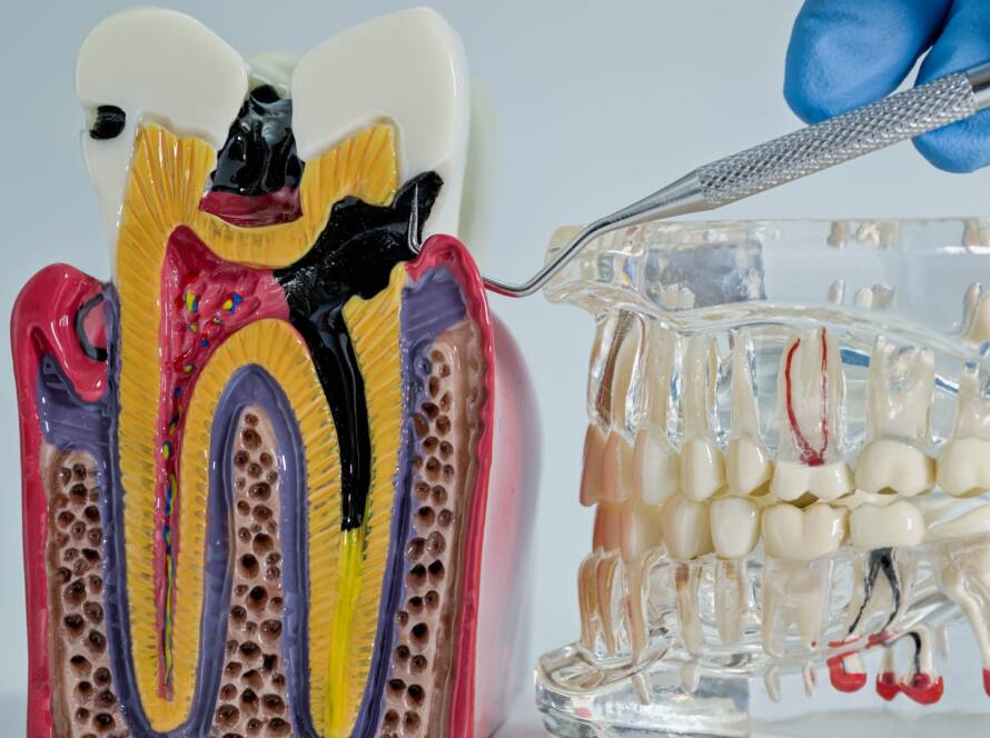 Pulpitis