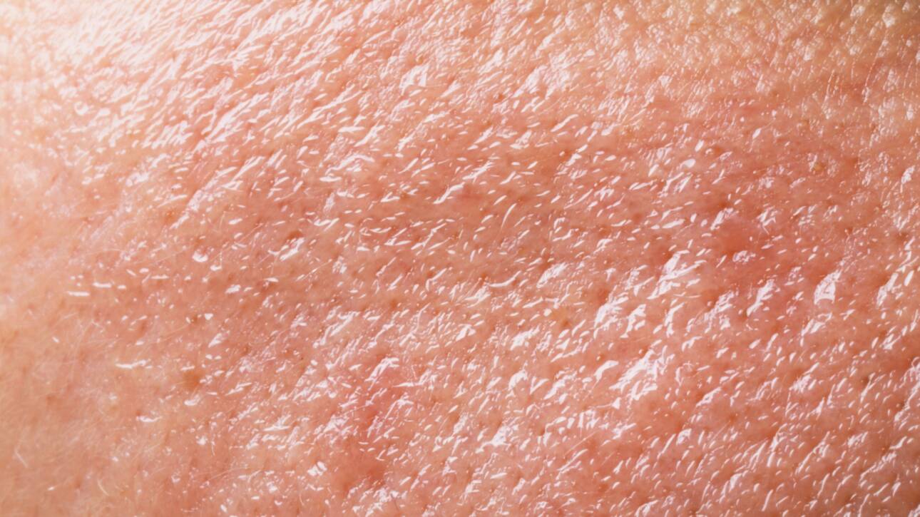 Razlika između dehidrirane i suhe kože, Dehydrated vs dry skin