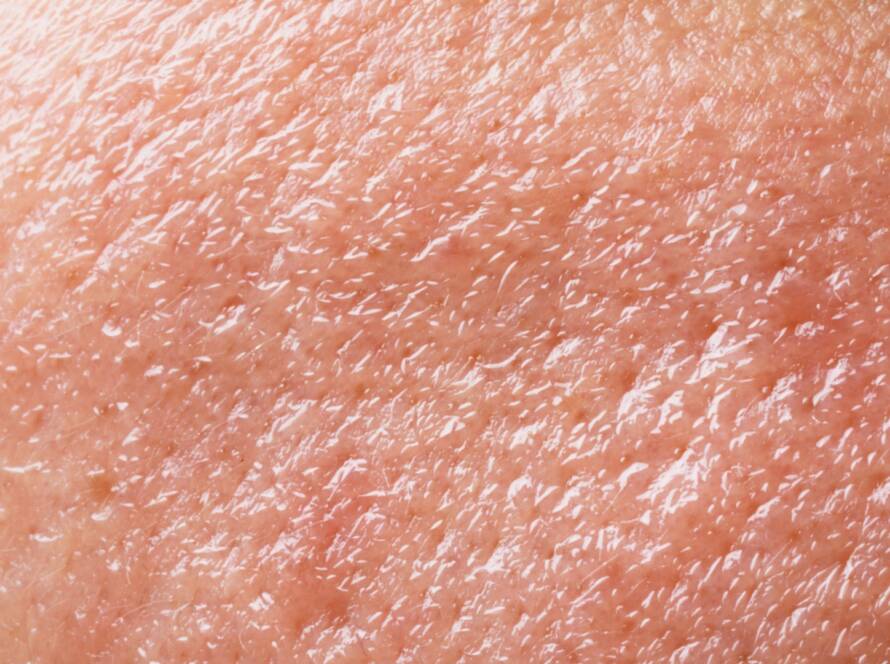 Razlika između dehidrirane i suhe kože, Dehydrated vs dry skin