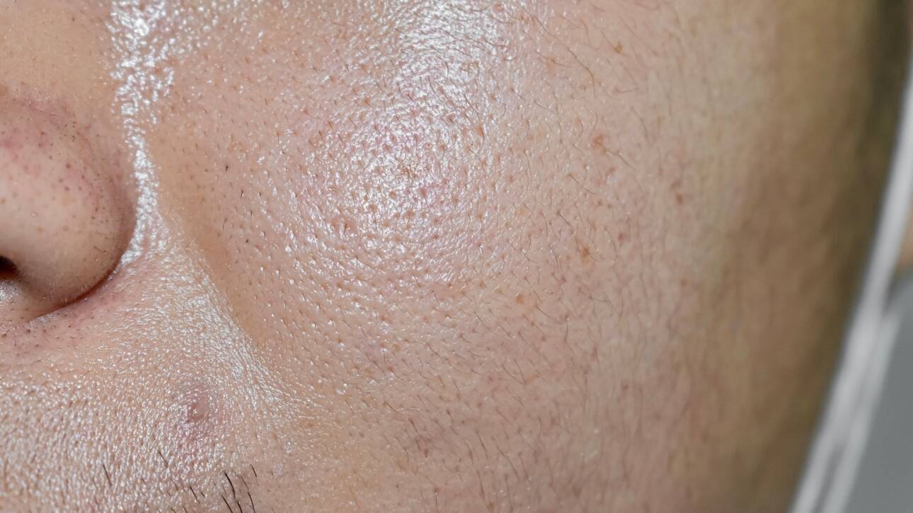 Masna koža, oily skin