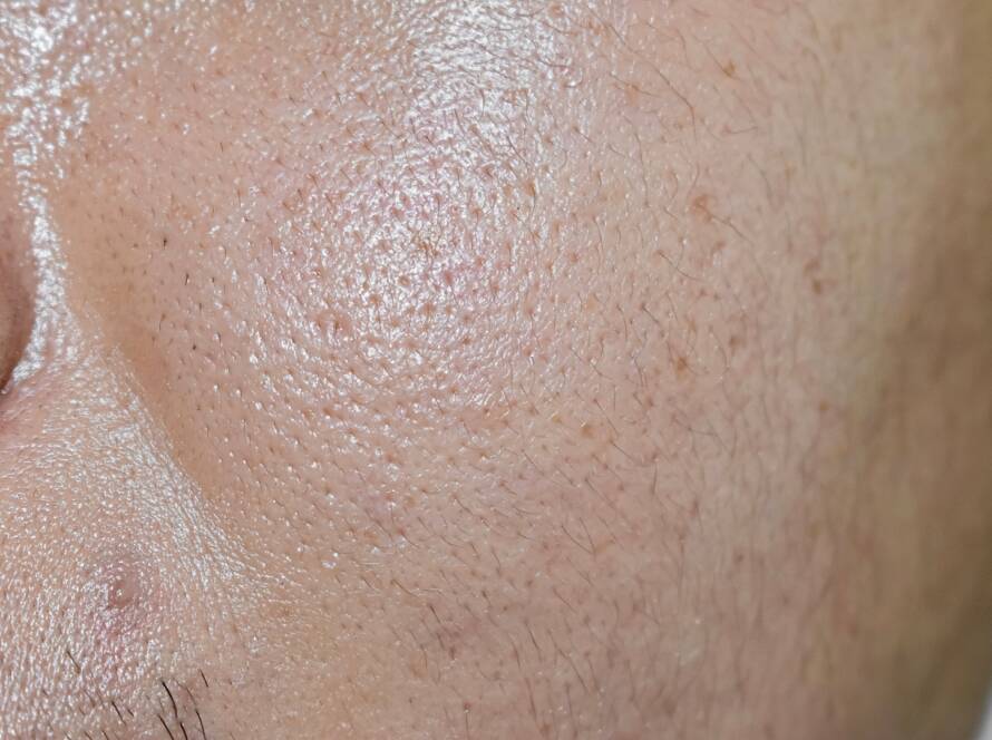 Masna koža, oily skin
