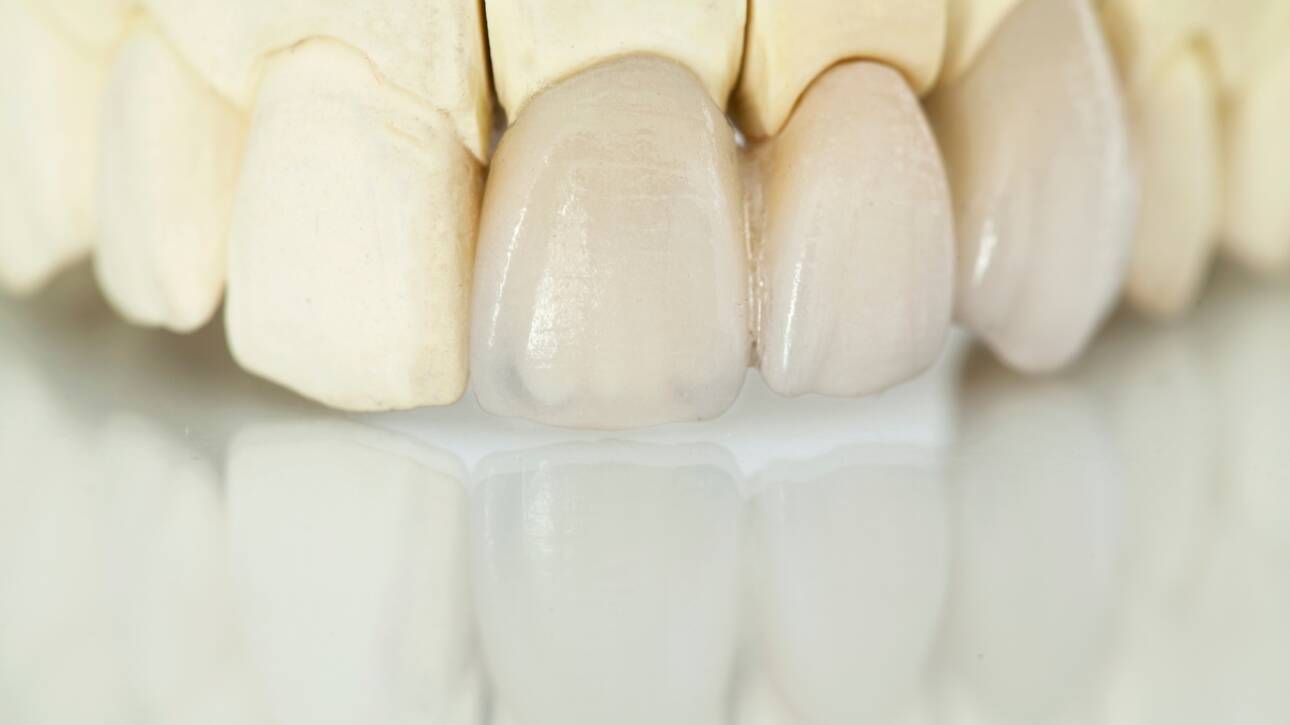 Zubne krunice, dental crowns