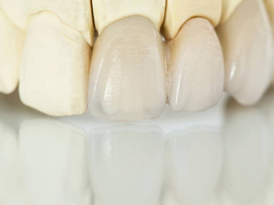 Zubne krunice, dental crowns